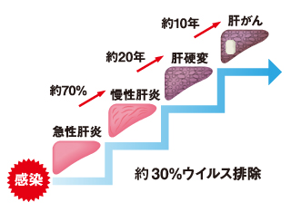 C型肝炎ウイルスの感染により慢性肝炎、肝硬変、肝がんに進行する場合があります