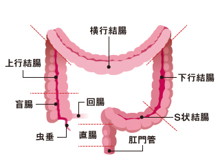 大腸がんの発生