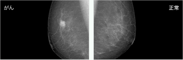 乳房Ｘ線（マンモグラフィ）検査