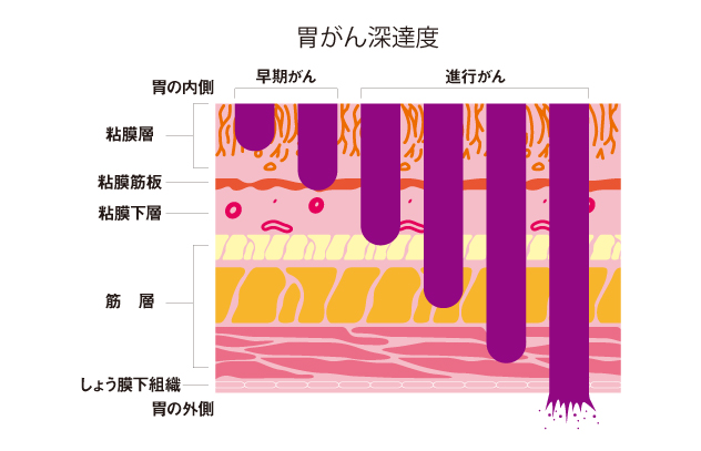 胃がんの発生