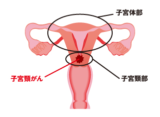 子宮頸がん